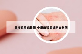 重度银屑病比例 中重度银屑病患者比例