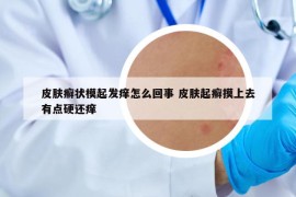 皮肤癣状模起发痒怎么回事 皮肤起癣摸上去有点硬还痒