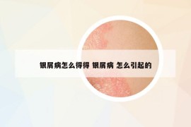 银屑病怎么得得 银屑病 怎么引起的