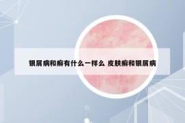 银屑病和癣有什么一样么 皮肤癣和银屑病