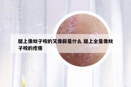 腿上像蚊子咬的又像藓是什么 腿上全是像蚊子咬的疙瘩