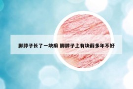 脚脖子长了一块癣 脚脖子上有块藓多年不好