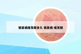 银屑病爆发期多久 银屑病 爆发期