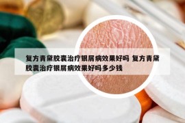 复方青黛胶囊治疗银屑病效果好吗 复方青黛胶囊治疗银屑病效果好吗多少钱