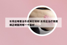 石家庄哪里治牛皮癣比较好 石家庄治疗银屑病正规医院哪一个最好