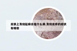 皮肤上发烧起癣会是什么病 发烧皮疹的症状有哪些