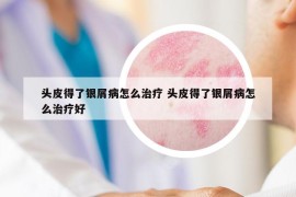 头皮得了银屑病怎么治疗 头皮得了银屑病怎么治疗好