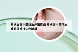 重庆去哪个医院治疗银屑病 重庆哪个医院治疗银屑病打生物制剂