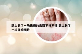 腿上长了一块像癣的东西不疼不痒 腿上长了一块像癣图片