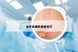 治疗白癜风用紫光灯