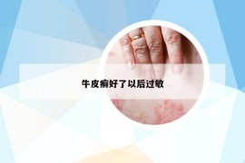 牛皮癣好了以后过敏