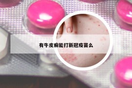 有牛皮癣能打新冠疫苗么