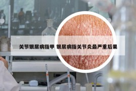 关节银屑病指甲 银屑病指关节炎最严重后果