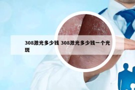 308激光多少钱 308激光多少钱一个光斑