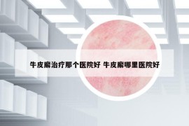 牛皮廨治疗那个医院好 牛皮廨哪里医院好