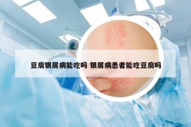 豆腐银屑病能吃吗 银屑病患者能吃豆腐吗