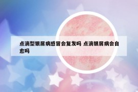 点滴型银屑病感冒会复发吗 点滴银屑病会自愈吗