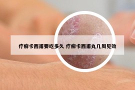 疗癣卡西甫要吃多久 疗癣卡西甫丸几周见效