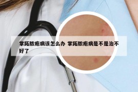 掌跖脓疱病该怎么办 掌跖脓疱病是不是治不好了