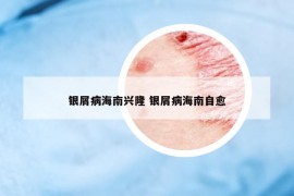 银屑病海南兴隆 银屑病海南自愈