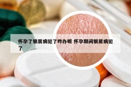 怀孕了银屑病犯了咋办呢 怀孕期间银屑病犯了