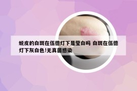 蜕皮的白斑在伍德灯下是莹白吗 白斑在伍德灯下灰白色!无真菌感染