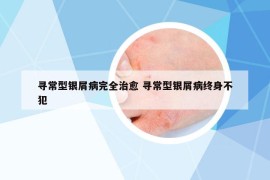 寻常型银屑病完全治愈 寻常型银屑病终身不犯