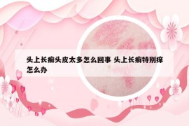 头上长癣头皮太多怎么回事 头上长癣特别痒怎么办