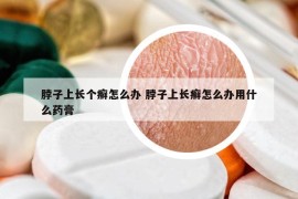 脖子上长个癣怎么办 脖子上长癣怎么办用什么药膏