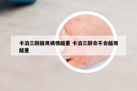 卡泊三醇越用病情越重 卡泊三醇会不会越用越重