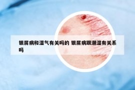 银屑病和湿气有关吗的 银屑病跟潮湿有关系吗