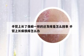 手臂上长了像癣一样的还发痒是怎么回事 手臂上长癣很痒怎么办