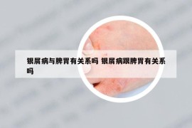 银屑病与脾胃有关系吗 银屑病跟脾胃有关系吗