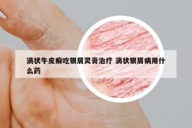 滴状牛皮癣吃银屑灵膏治疗 滴状银屑病用什么药