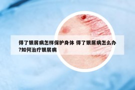 得了银屑病怎样保护身体 得了银屑病怎么办?如何治疗银屑病