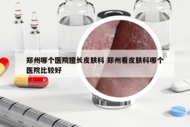 郑州哪个医院擅长皮肤科 郑州看皮肤科哪个医院比较好