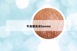 牛皮癣出水haoma