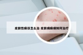 皮肤性癣该怎么治 皮肤病癣病如何治疗