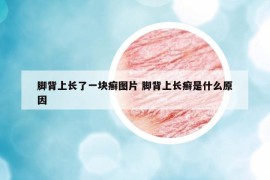 脚背上长了一块癣图片 脚背上长癣是什么原因