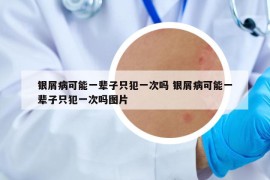 银屑病可能一辈子只犯一次吗 银屑病可能一辈子只犯一次吗图片