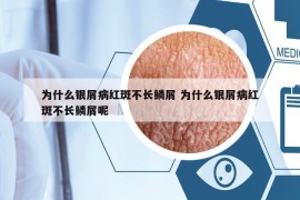 为什么银屑病红斑不长鳞屑 为什么银屑病红斑不长鳞屑呢