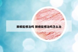 脚癣能根治吗 脚癣能根治吗怎么治