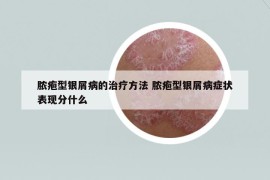 脓疱型银屑病的治疗方法 脓疱型银屑病症状表现分什么