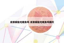 皮肤癣能吃鲍鱼吗 皮肤癣能吃鲍鱼吗图片