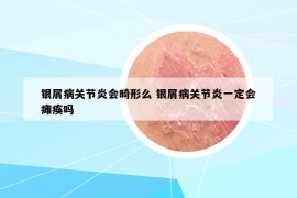 银屑病关节炎会畸形么 银屑病关节炎一定会瘫痪吗