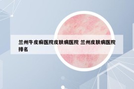 兰州牛皮癣医院皮肤病医院 兰州皮肤病医院排名