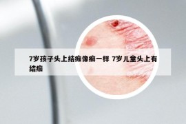 7岁孩子头上结痂像癣一样 7岁儿童头上有结痂