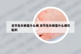 关节处长癣是什么病 关节处长癣是什么病引起的