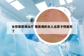 女性银屑病治疗 银屑病的女人这辈子彻底完了