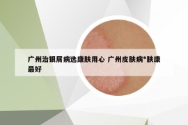 广州治银屑病选康肤用心 广州皮肤病*肤康最好